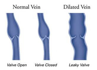 Varicose Vein Stripping Treatment vs. Sclerotherapy: Goldman Vein